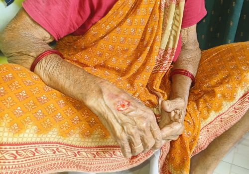 కోతుల దాడిలో వృద్ధురాలికి తీవ్ర గాయం: రంగావారి వీధిలో భయాందోళన